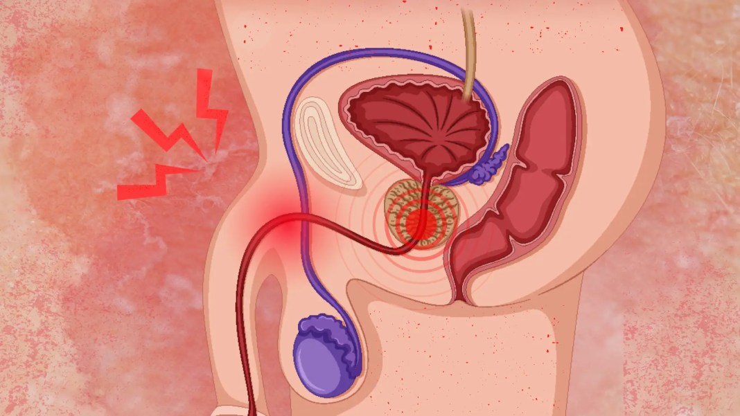 أسباب وراء ضيق مجرى البول وطرق علاجه