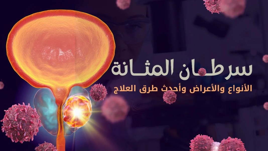 علاج سرطان المثانة