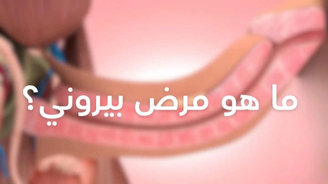 مرض بيروني (انحناء القضيب) | الأسباب - الأعراض - العلاج